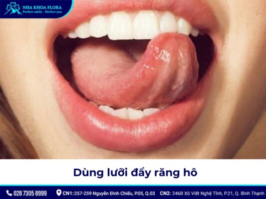 niềng răng hô tại nhà - ảnh 9