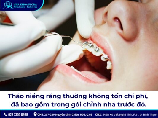 tháo niềng răng - ảnh 4