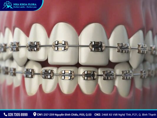 nên niềng răng kim loại hay sứ - ảnh 1