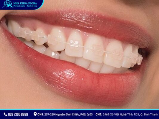 nên niềng răng kim loại hay sứ - ảnh 2