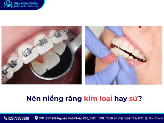 nên niềng răng kim loại hay sứ - ảnh 3