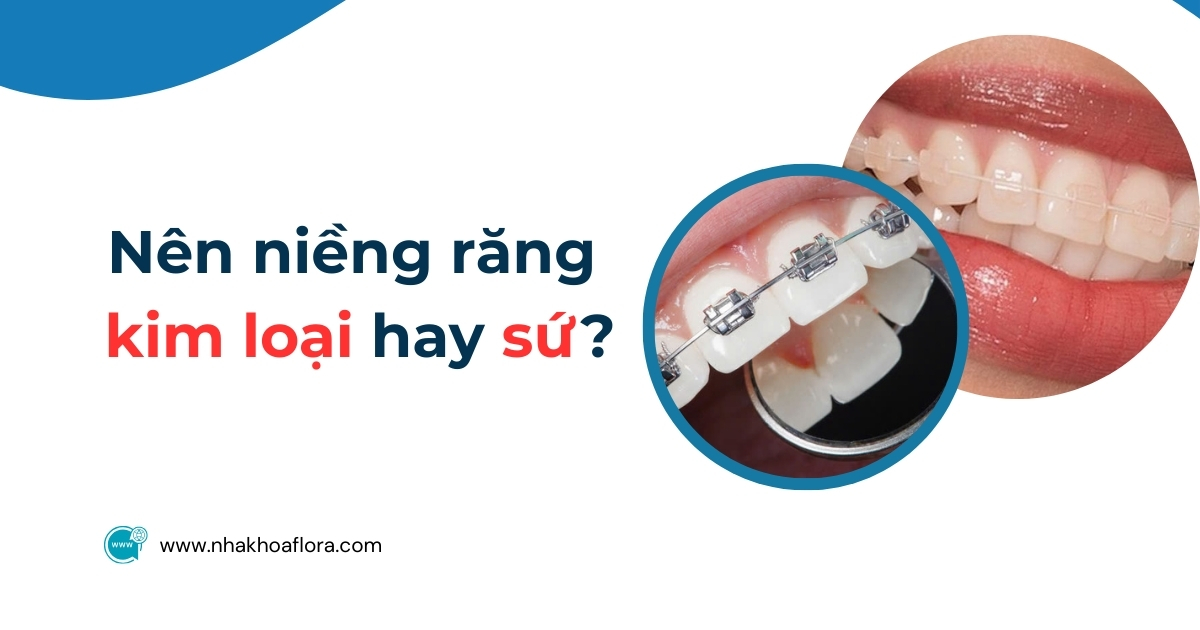 nên niềng răng kim loại hay sứ