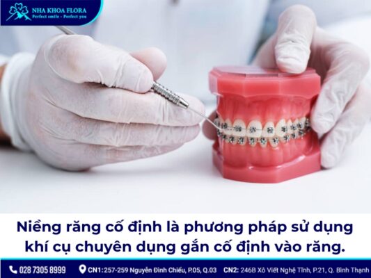 niềng răng cố định - ảnh 1