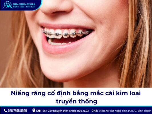 niềng răng cố định - ảnh 2