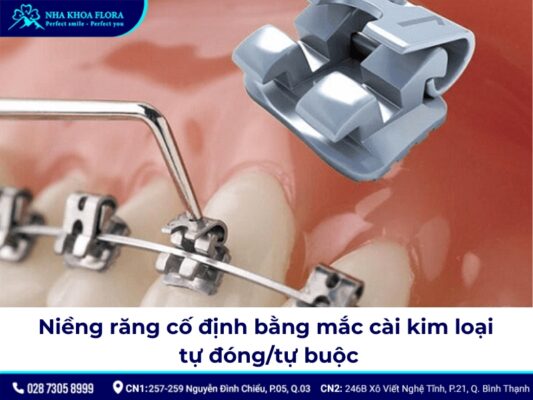 niềng răng cố định - ảnh 3