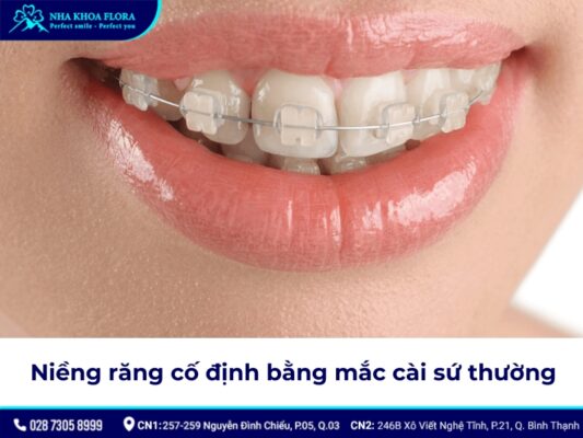 niềng răng cố định - ảnh 4