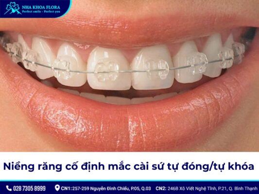 niềng răng cố định - ảnh 5