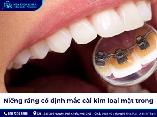 niềng răng cố định - ảnh 6