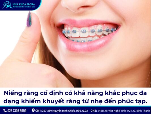 niềng răng cố định - ảnh 7