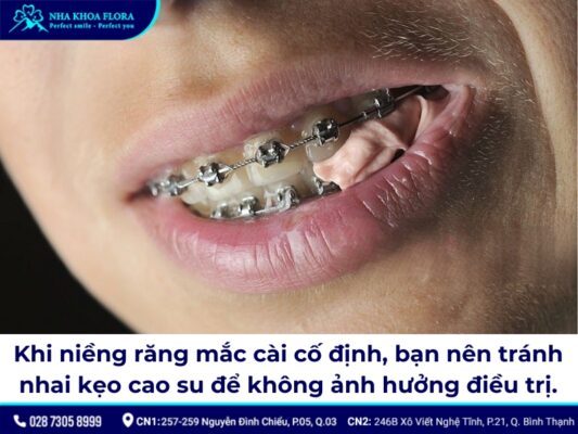 niềng răng cố định - ảnh 8