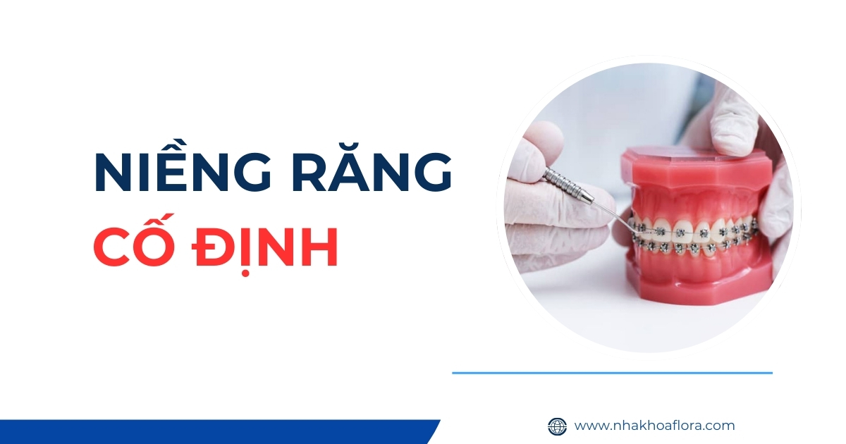 niềng răng cố định