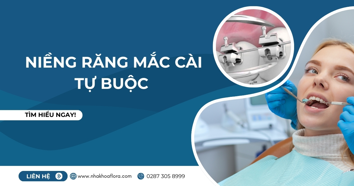 niềng răng mắc cài tự buộc