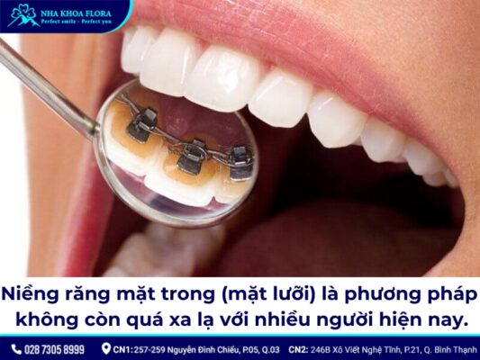 niềng răng mặt trong - ảnh 1