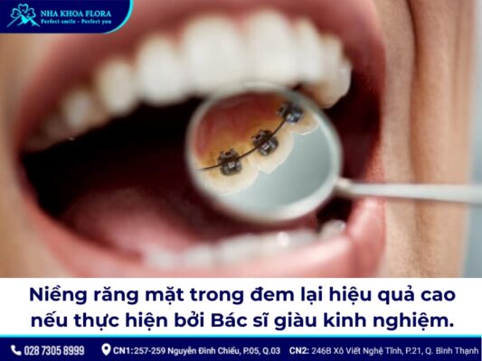 niềng răng mặt trong - ảnh 2