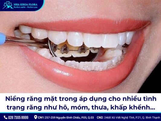 niềng răng mặt trong - ảnh 3