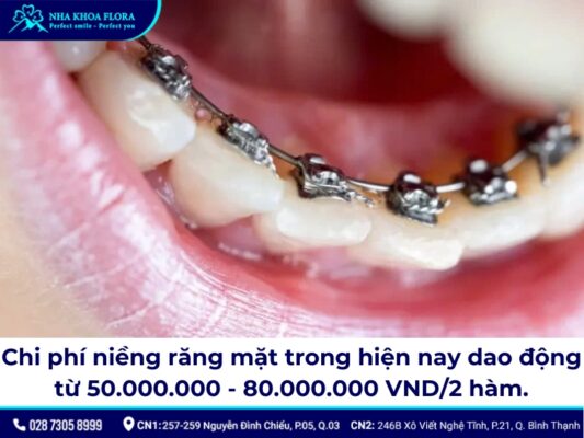 niềng răng mặt trong - ảnh 4