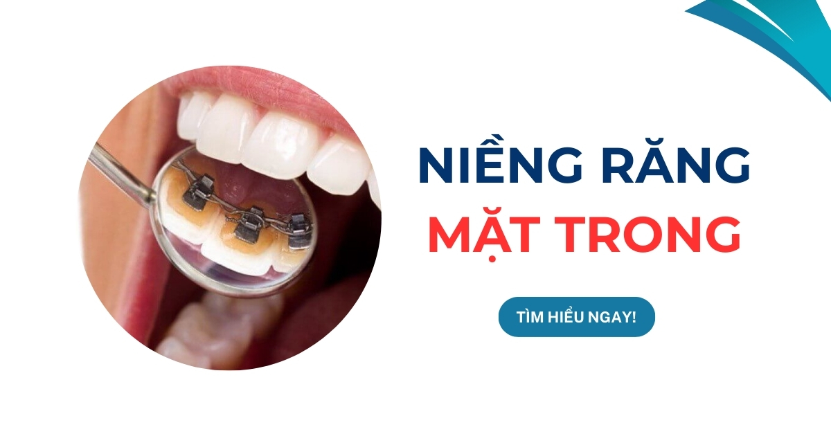 niềng răng mặt trong
